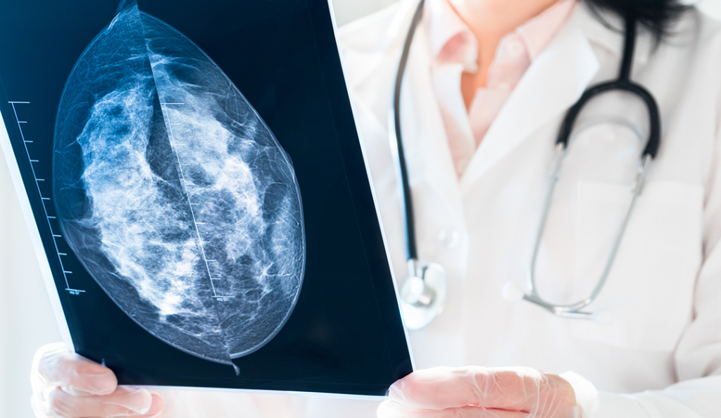 Understanding the aggressive breast cancers missed by mammogram screening